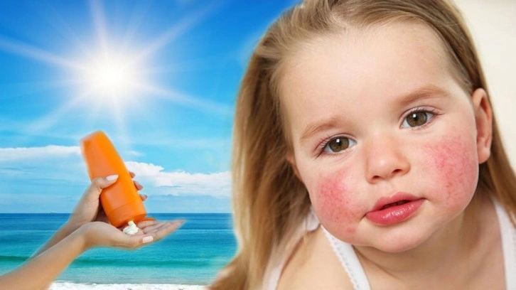Güneş alerjisine ne iyi gelir, nasıl geçer? Güneş alerjisi belirtileri nelerdir?