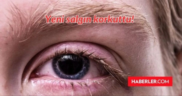 Kırmızı Göz hastalığı nedir, tedavisi var mı? Pakistan'da çıkan yeni virüs, salgın ne?