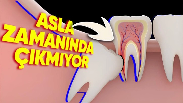 Yirmilik Dişler Neden Zamanında Çıkmaz?