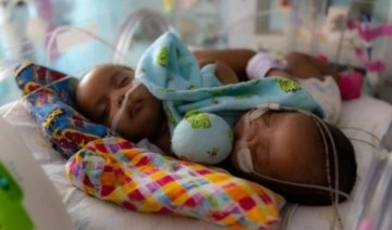 Dört aylık yapışık ikiz bebekler, 11 saat süren ameliyat sonucunda ayrıldılar