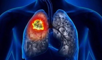 İl Sağlık Müdürü Korkmaz'dan kritik 'akciğer kanseri' açıklaması