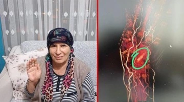 Kalçasını kırıp doktora giden yaşlı kadının vücudunda unutulan parça akıllara zarar