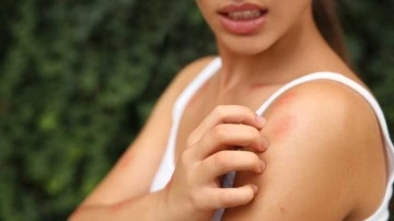 Sivrisinek yüzünden cildinizi tahriş etmeyin işte kaşıntıyı geçirecek doğal yöntemler!