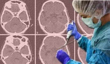 Yaygın görülen beyin kanserinin alt türleri ortaya çıktı